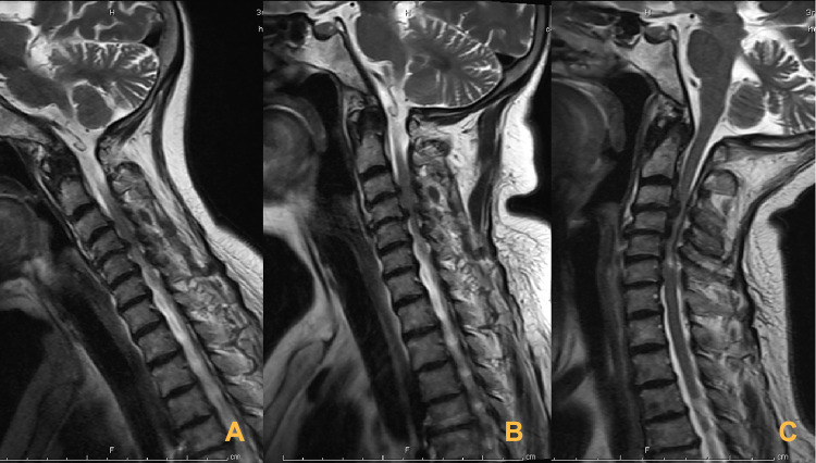 Traumatic Central Cord Syndrome — Figure 2