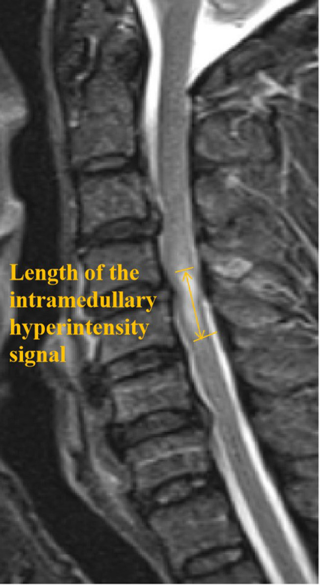 Traumatic Central Cord Syndrome — Figure 3