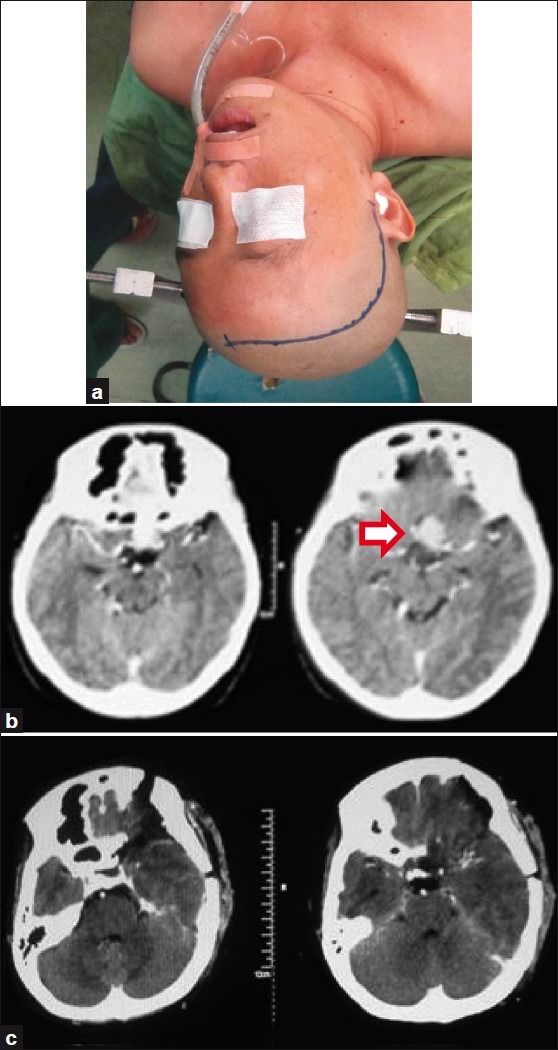 Tuberculum Sellae Meningioma Resection — Figure 1
