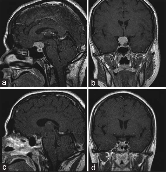 Tuberculum Sellae Meningioma Resection — Figure 1