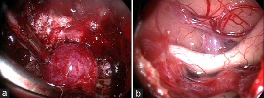 Tuberculum Sellae Meningioma Resection — Figure 2