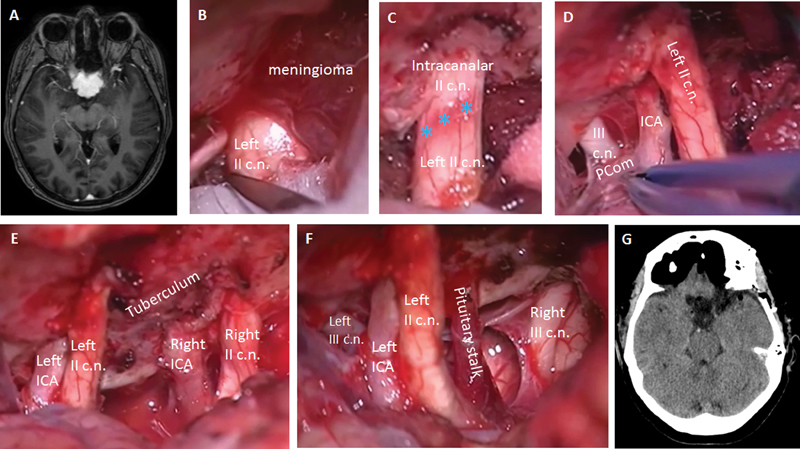 Tuberculum Sellae Meningioma Resection — Fig. 1