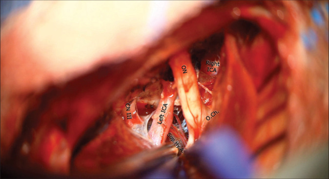 Tuberculum Sellae Meningioma Resection — Figure