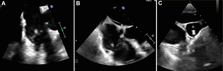 Ventriculoatrial Shunt Placement — Figure