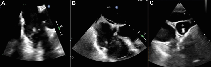 Ventriculoatrial Shunt Placement — Figure 1