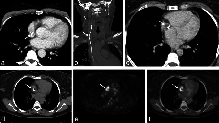 Ventriculoatrial Shunt Placement — Fig. 1