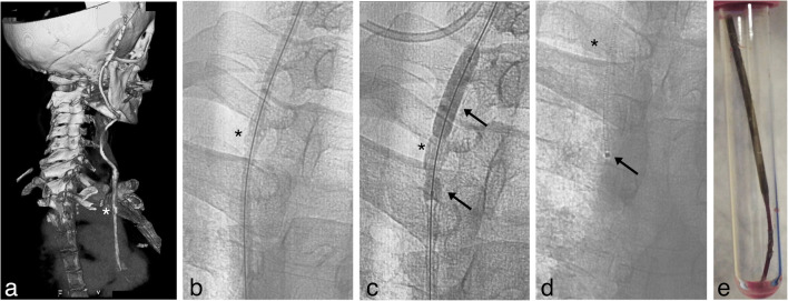Ventriculoatrial Shunt Placement — Fig. 2
