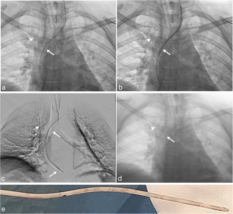 Ventriculoatrial Shunt Placement — Fig. 3
