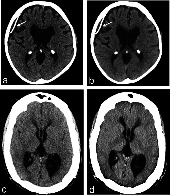 Ventriculoatrial Shunt Placement — Fig. 4