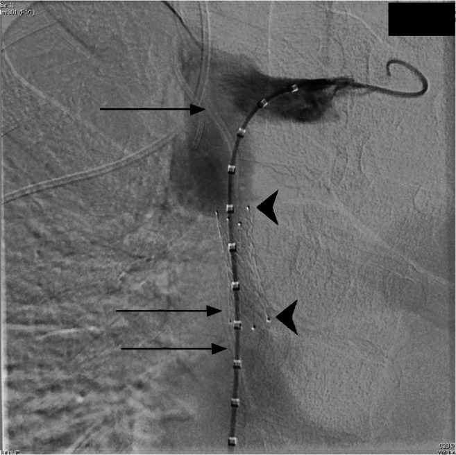 Ventriculoatrial Shunt Placement — Fig. 1