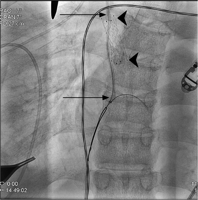 Ventriculoatrial Shunt Placement — Fig. 2