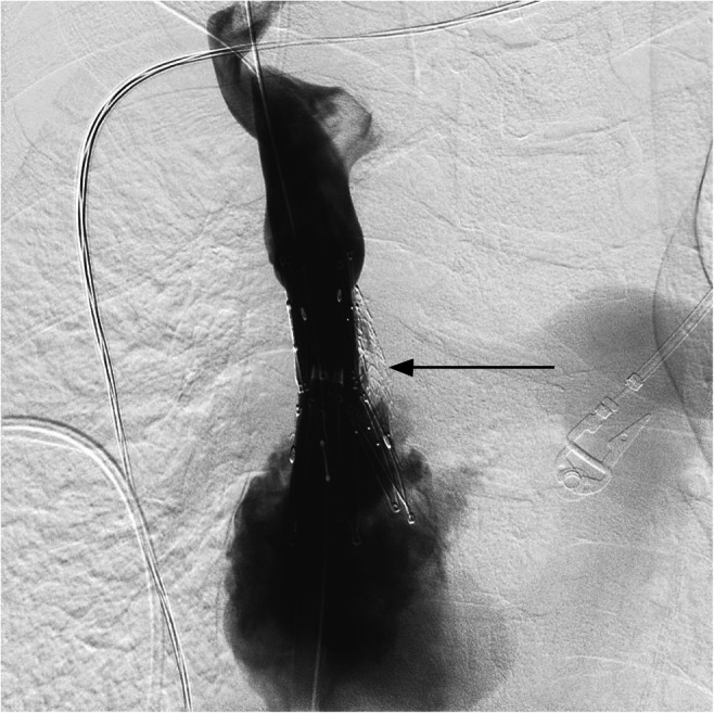 Ventriculoatrial Shunt Placement — Fig. 3