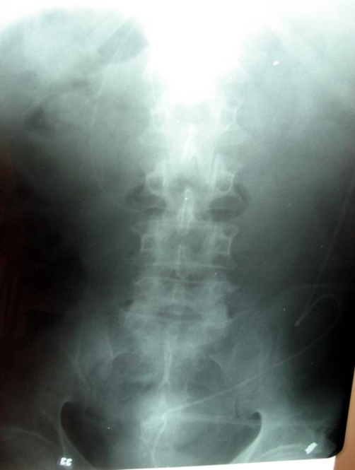 Ventriculoperitoneal Shunt Placement — Figure 2.