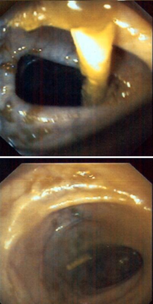 Ventriculoperitoneal Shunt Placement — Figure 3.