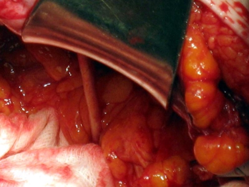 Ventriculoperitoneal Shunt Placement — Figure 4.