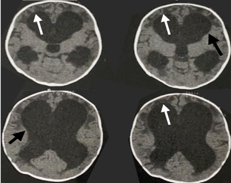 Ventriculoperitoneal Shunt Placement — Figure 1