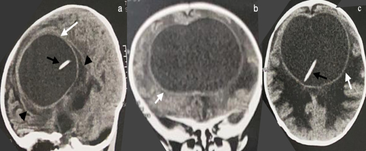 Ventriculoperitoneal Shunt Placement — Figure 2