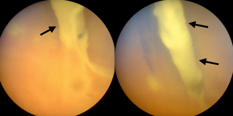 Ventriculoperitoneal Shunt Placement — Figure 3