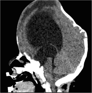 Ventriculopleural Shunt Placement — Fig. 1