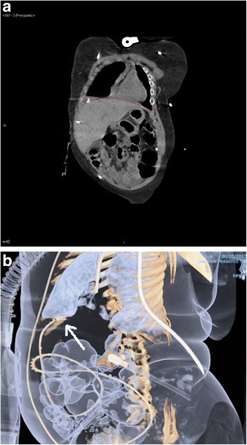 Ventriculopleural Shunt Placement — Fig. 2