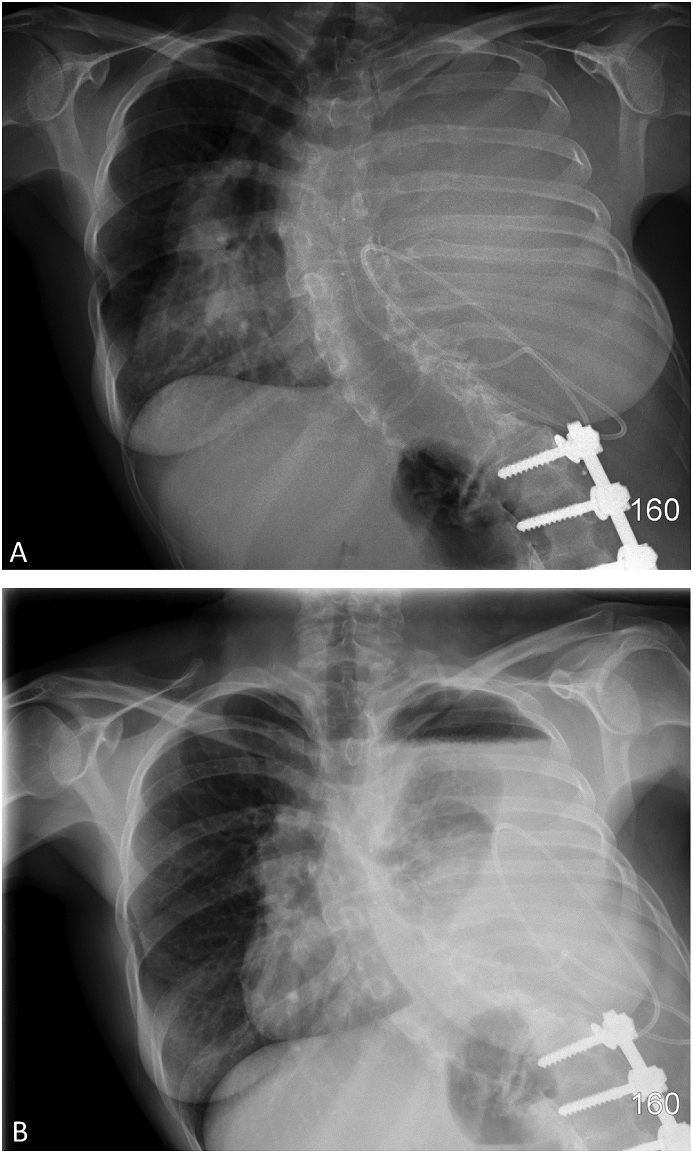 Ventriculopleural Shunt Placement — Fig. 1