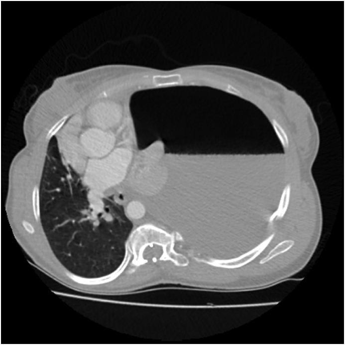Ventriculopleural Shunt Placement — Fig. 2