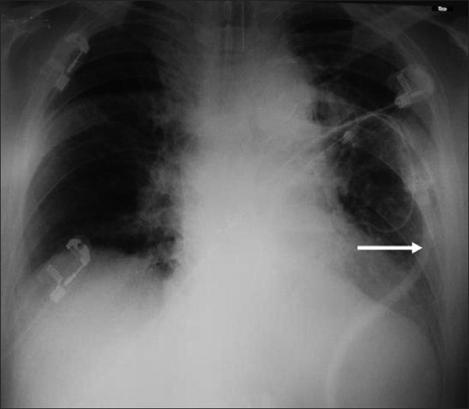 Ventriculopleural Shunt Placement — Figure 1