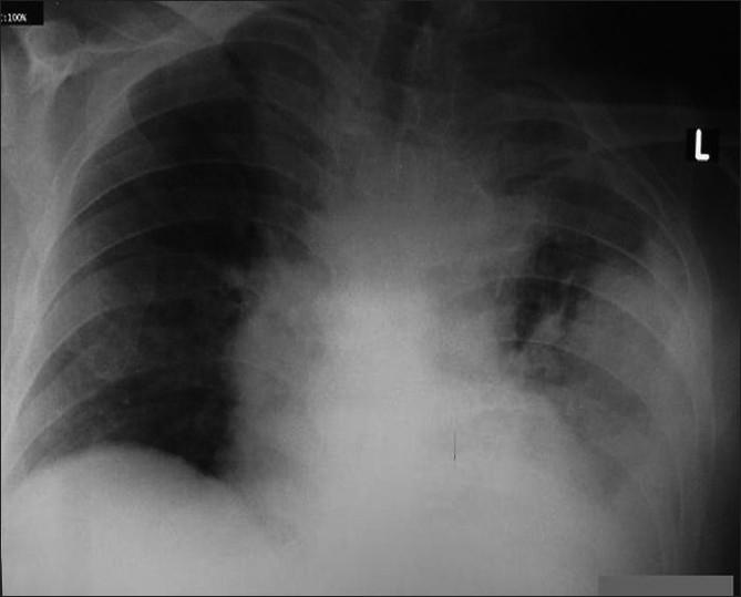 Ventriculopleural Shunt Placement — Figure 2