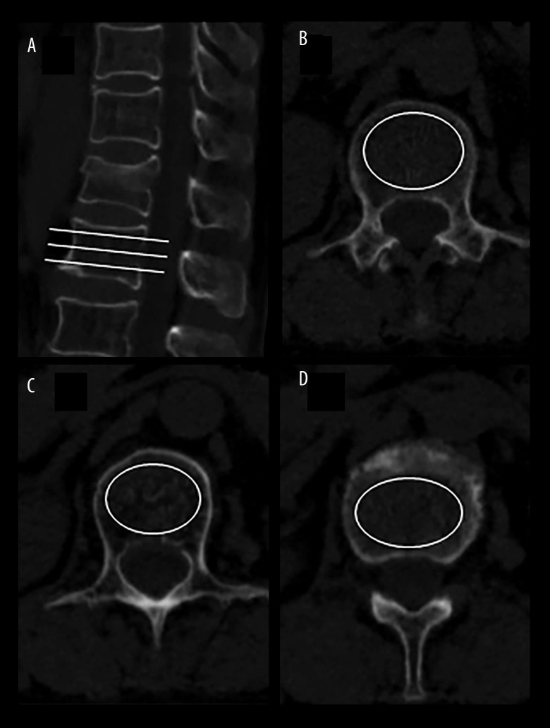 Vertebral Augmentation — Figure 1