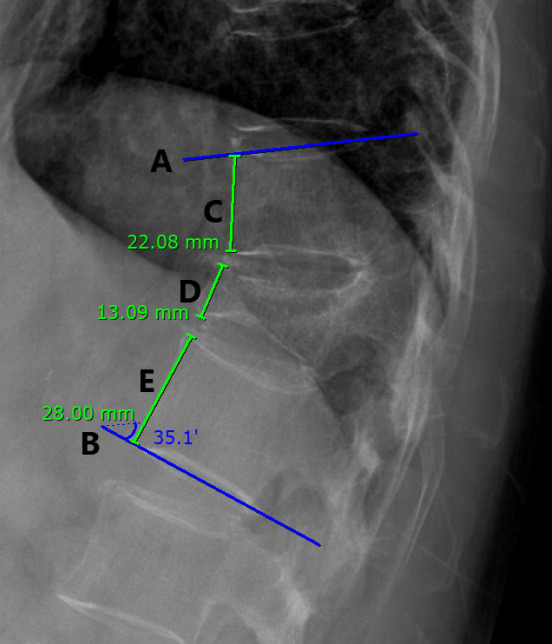 Vertebral Augmentation — Fig. 1.