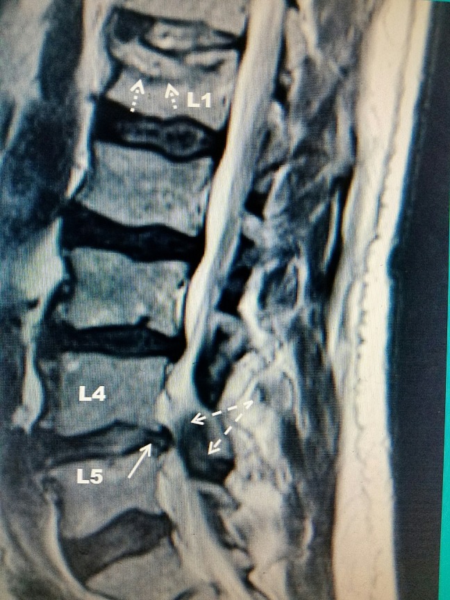 Vertebral Augmentation — Figure 1