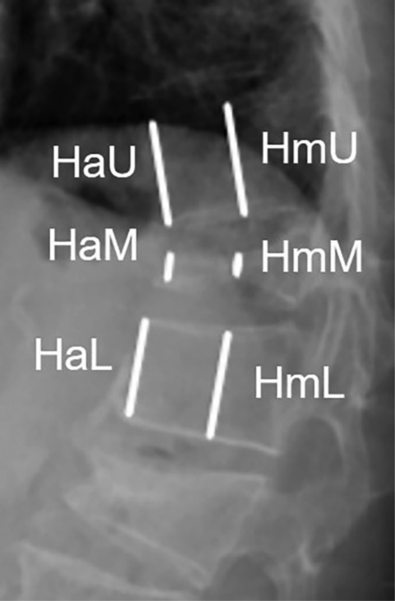 Vertebral Augmentation — Figure 1
