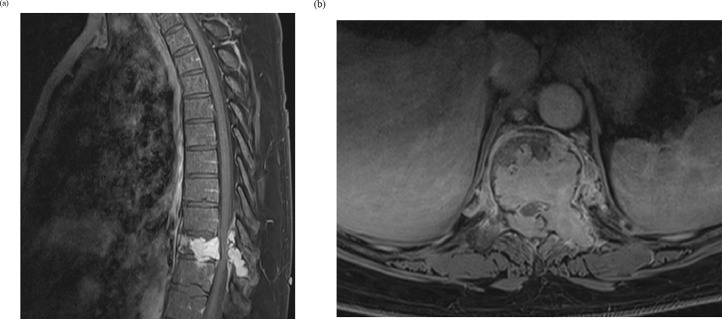 Vertebral Corpectomy Reconstruction — Fig. 1