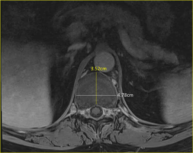 Vertebral Corpectomy Reconstruction — Fig. 2