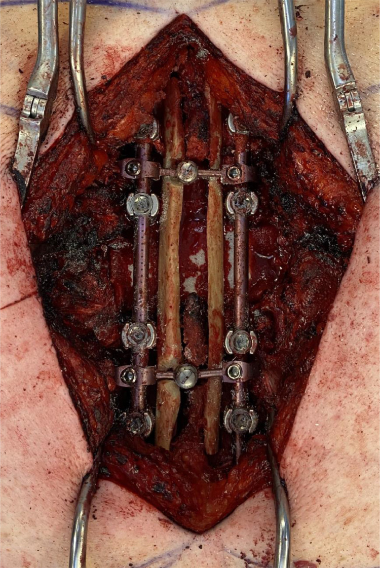 Vertebral Corpectomy Reconstruction — Fig. 3
