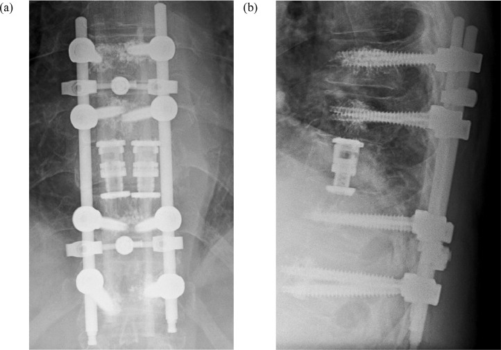 Vertebral Corpectomy Reconstruction — Fig. 4