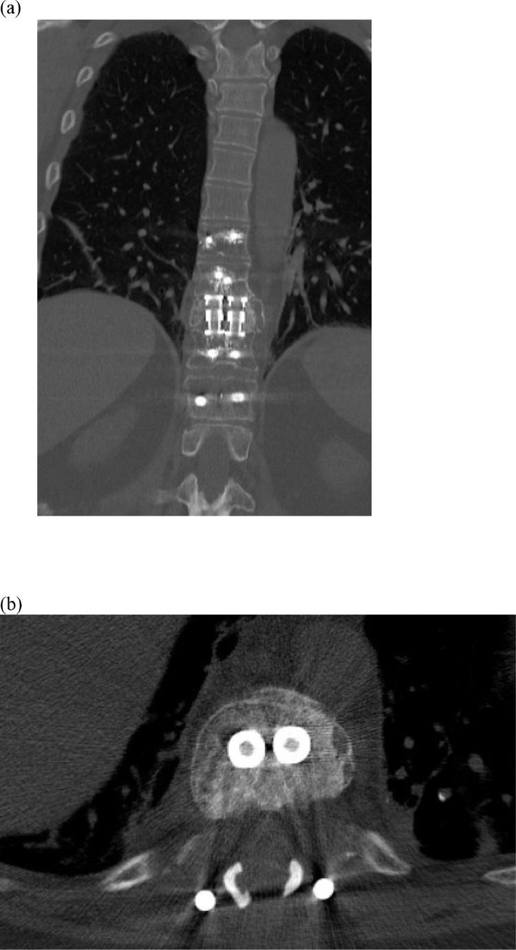 Vertebral Corpectomy Reconstruction — Fig. 5