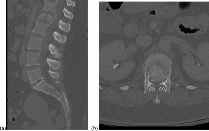 Vertebral Corpectomy Reconstruction — Fig. 6