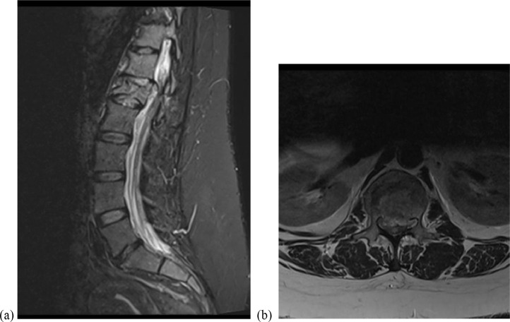 Vertebral Corpectomy Reconstruction — Fig. 7