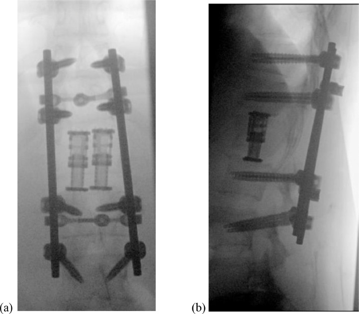 Vertebral Corpectomy Reconstruction — Fig. 8