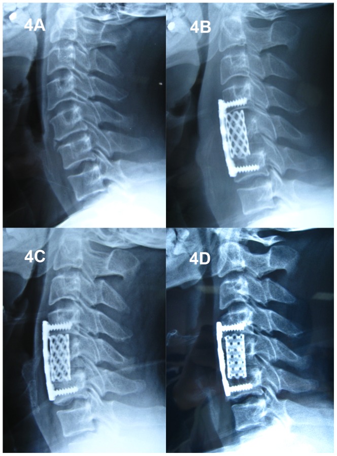 Vertebral Corpectomy Reconstruction — Figure 4