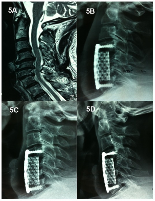 Vertebral Corpectomy Reconstruction — Figure 5