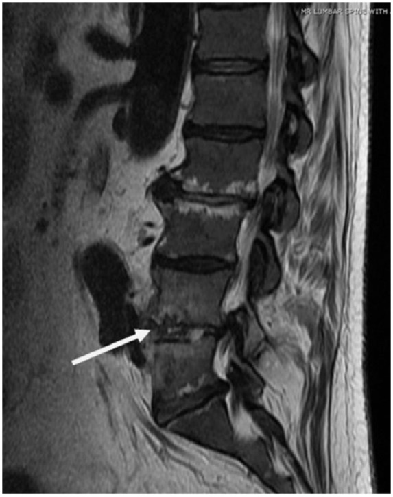 Vertebral Osteomyelitis Discitis Surgical Management — Figure 1.