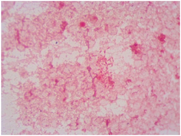 Vertebral Osteomyelitis Discitis Surgical Management — Figure 2.