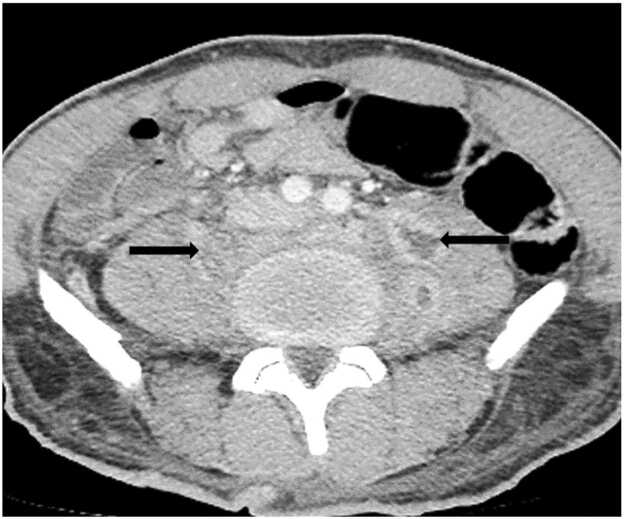Vertebral Osteomyelitis Discitis Surgical Management — Fig. 1