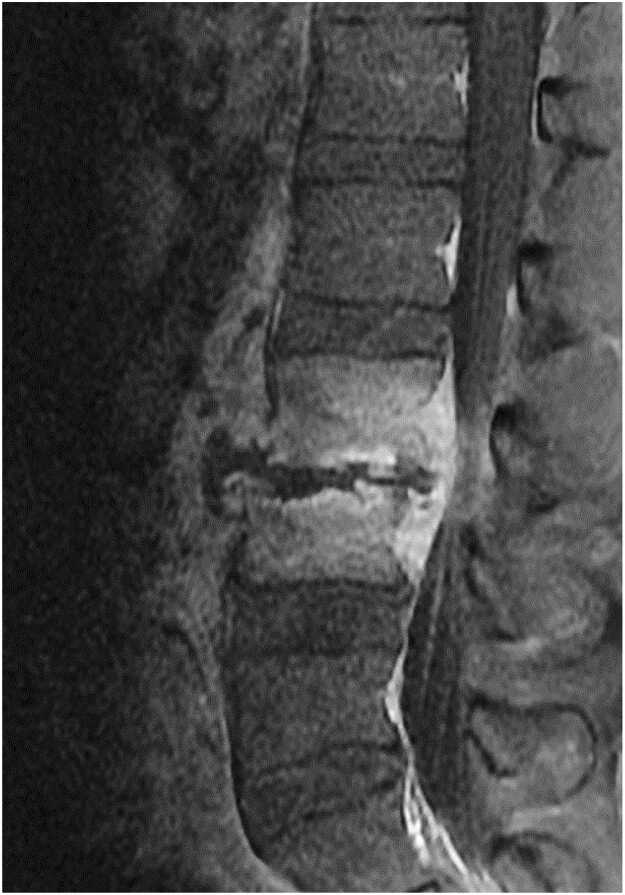 Vertebral Osteomyelitis Discitis Surgical Management — Fig. 2
