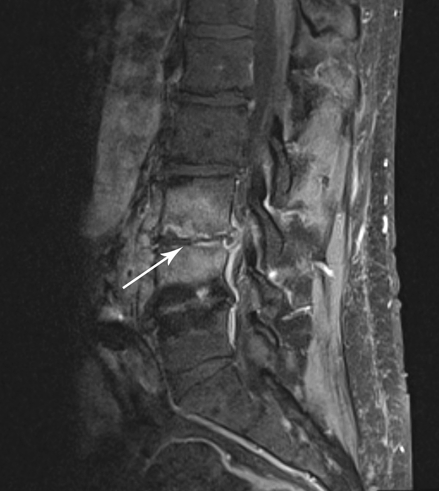 Vertebral Osteomyelitis Discitis Surgical Management — Fig. 1