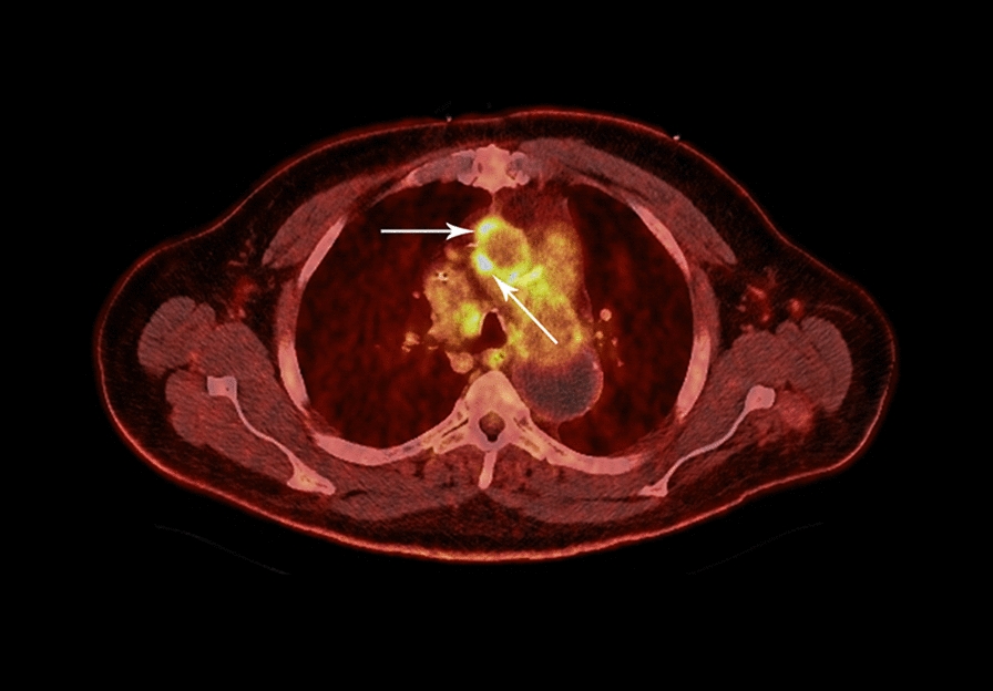Vertebral Osteomyelitis Discitis Surgical Management — Fig. 3