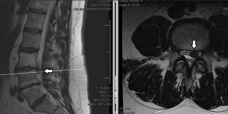 Vertebral Osteomyelitis Discitis Surgical Management — Figure 1