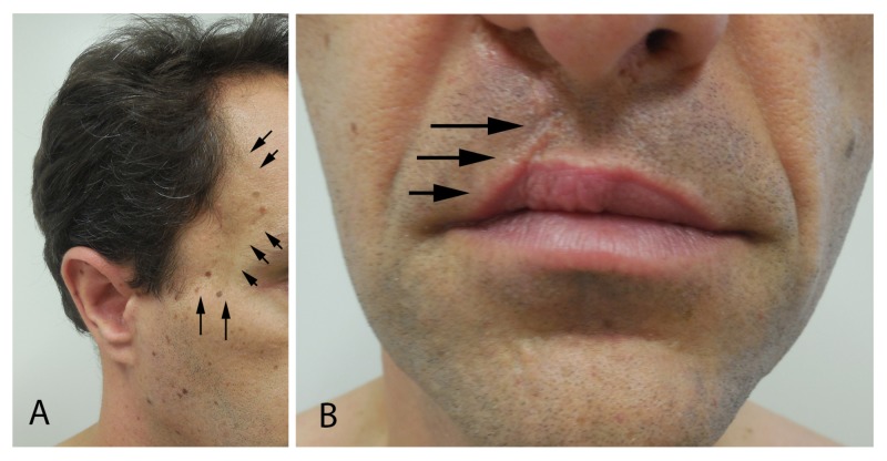 Vestibular Schwannoma Resection — Figure 1